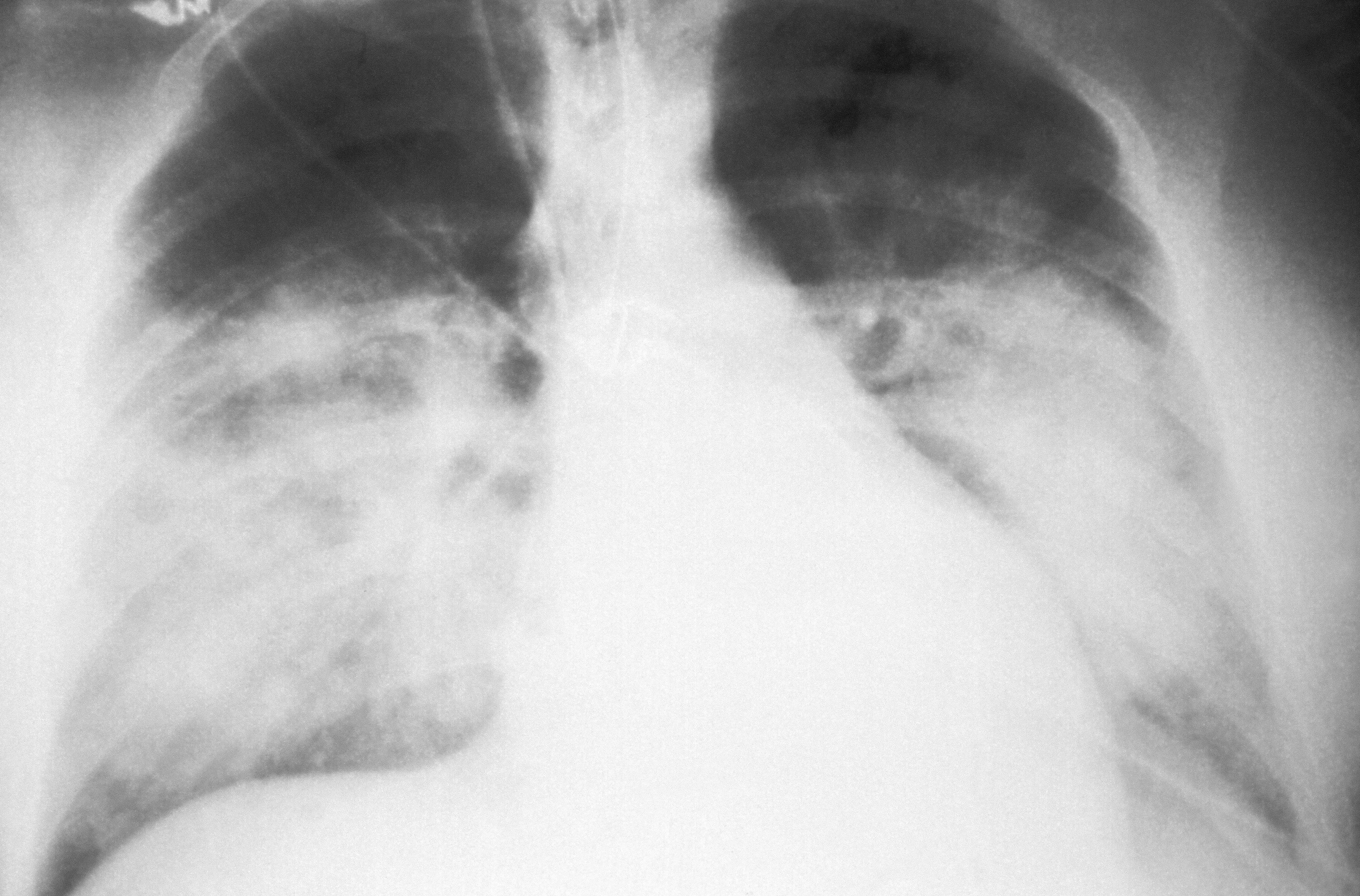 ID#: 6076 Caption: This AP chest x-ray reveals the mid-staged bilateral pulmonary effusion caused by hantavirus pulmonary syndrome, or HPS. Radiologically, HPS begins with interstitial pulmonary edema, progressing to alveolar edema with severe bilateral involvement. Pleural effusions are common, and are often large enough to be evident radiographically, as was the case, here. Content Provider(s): CDC/ D. Loren Ketai, M.D. https://wwwn.cdc.gov/phil/Details.aspx?pid=6076